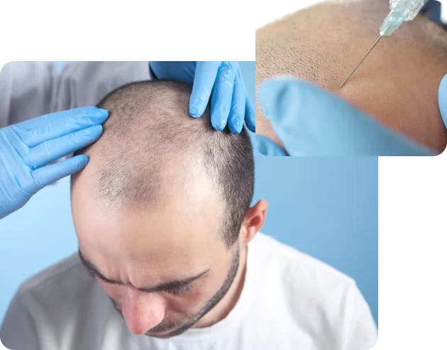 Top Symptoms of Androgenetic Alopecia