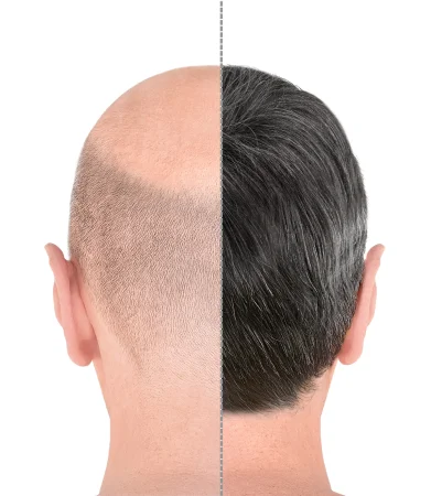 Gain Confidence with a Hair Transplant