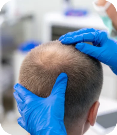 Is Rogaine® Effective for Restoring Hair Loss?